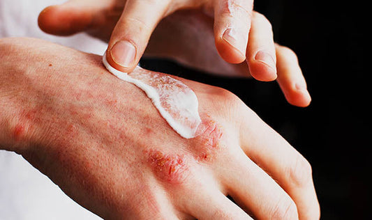 How to Calm an Eczema/Psoriasis Flare-Up Without Reaching for Steroids.