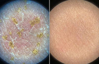 What Is Eczema?